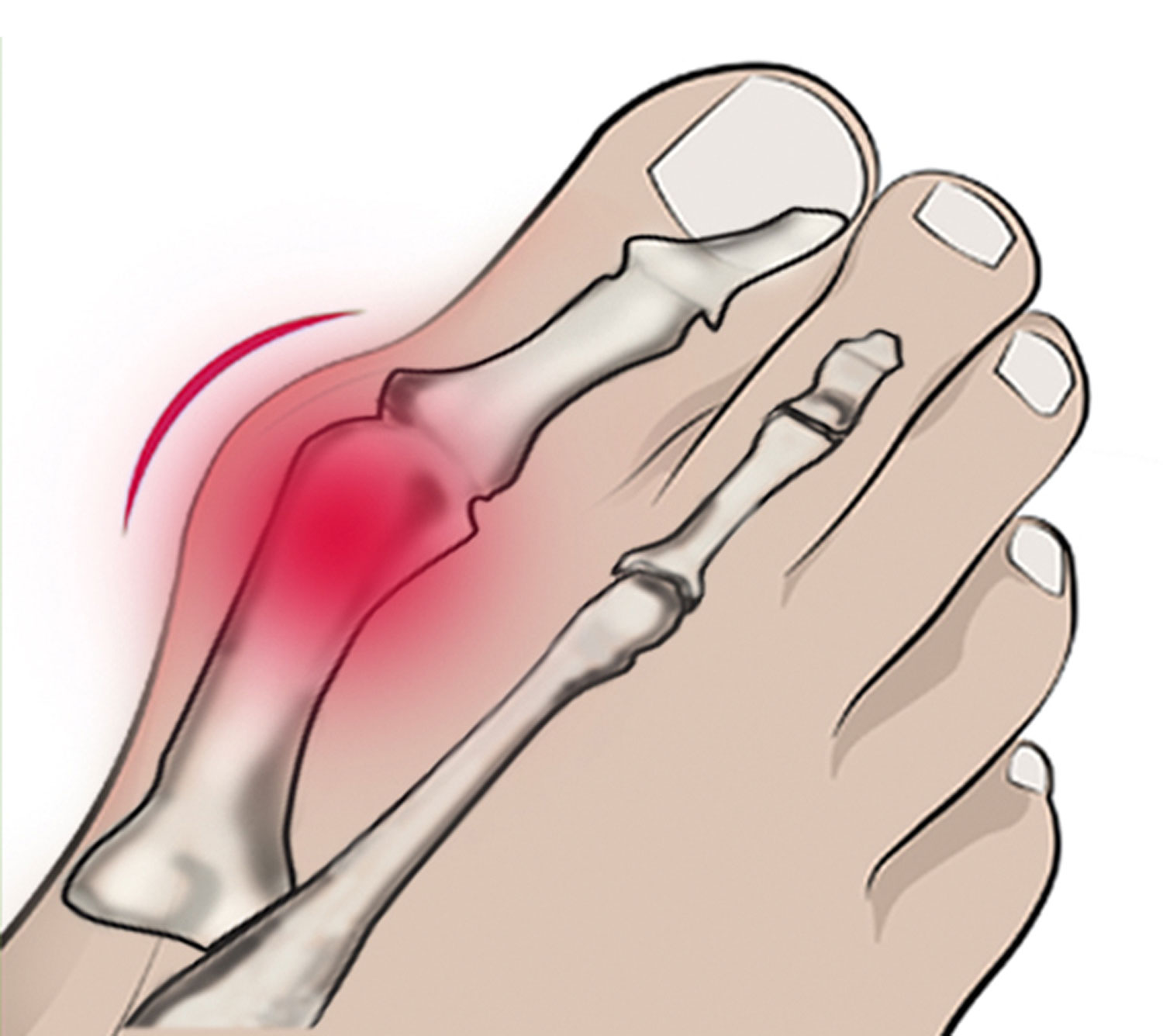 Vital Comfort Hallux-valgus-Schutz und Zehenspreizer03