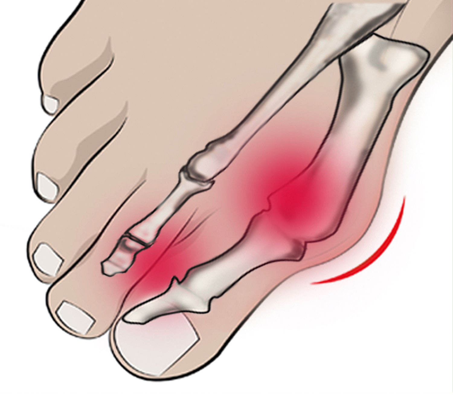 Vital Comfort Hallux-valgus- und Mittelfu-Kissen03
