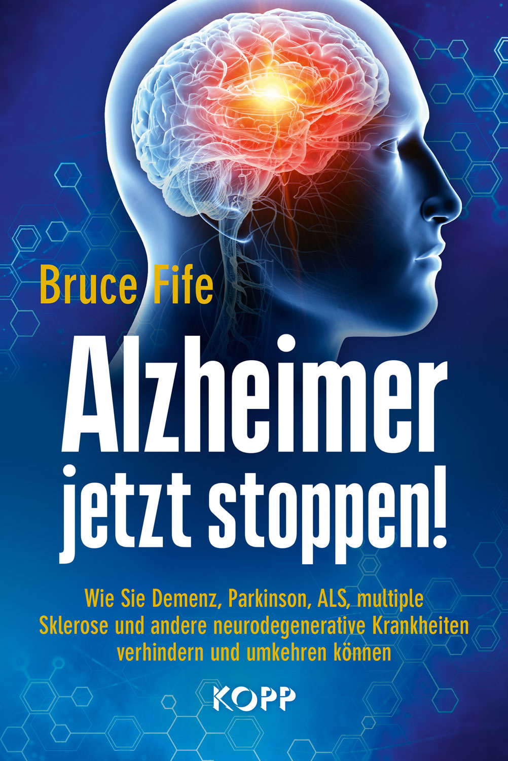 Alzheimer jetzt stoppen! - Mngelartikel