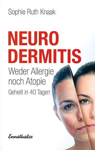 Neurodermitis - Weder Allergie noch Atopie